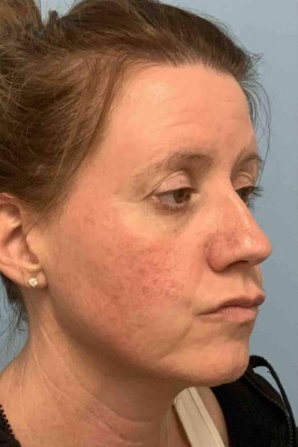 Laser Resurfacing Before & After Patient #11197