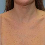 Laser Resurfacing Before & After Patient #11200