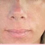Laser Resurfacing Before & After Patient #11203