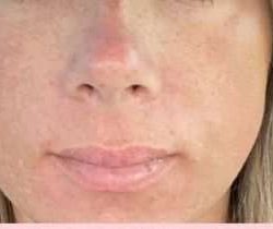 Laser Resurfacing Before & After Patient #11203