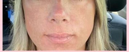 Laser Resurfacing Before & After Patient #11203