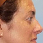Laser Resurfacing Before & After Patient #11208