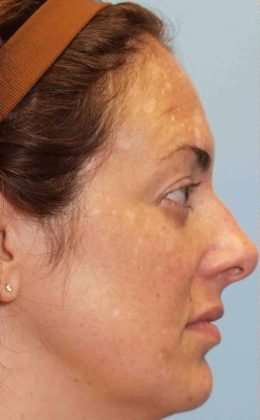 Laser Resurfacing Before & After Patient #11208