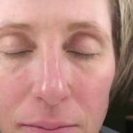 Laser Resurfacing Before & After Patient #11215