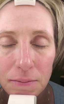 Laser Resurfacing Before & After Patient #11215