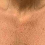 Laser Resurfacing Before & After Patient #11225