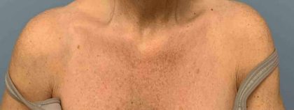 Laser Resurfacing Before & After Patient #11225