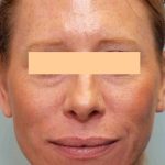 Laser Resurfacing Before & After Patient #11228