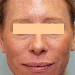 Laser Resurfacing Before & After Patient #11228