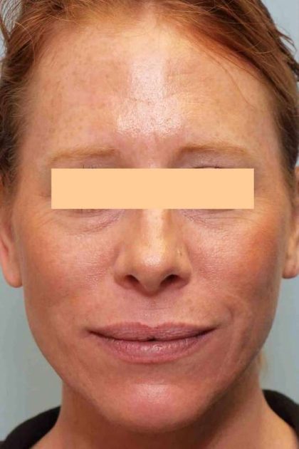 Laser Resurfacing Before & After Patient #11228