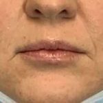 Fillers Before & After Patient #11263