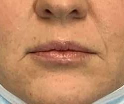 Fillers Before & After Patient #11263