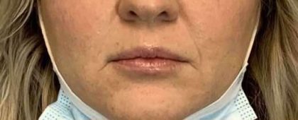 Fillers Before & After Patient #11263