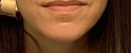Fillers Before & After Patient #11266