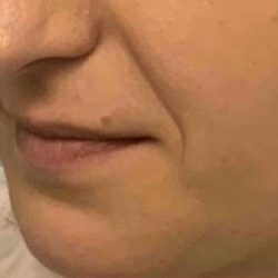 Fillers Before & After Patient #11269