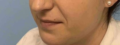 Fillers Before & After Patient #11269