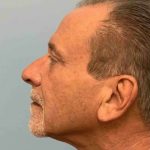 Fillers Before & After Patient #11276
