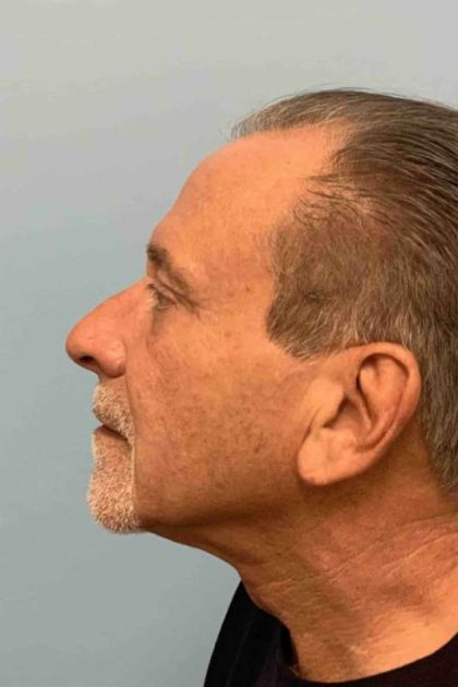 Fillers Before & After Patient #11276