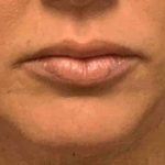 Fillers Before & After Patient #11283