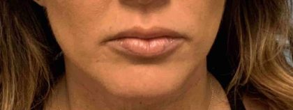 Fillers Before & After Patient #11283