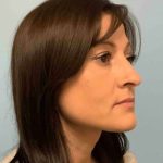 Fillers Before & After Patient #11288