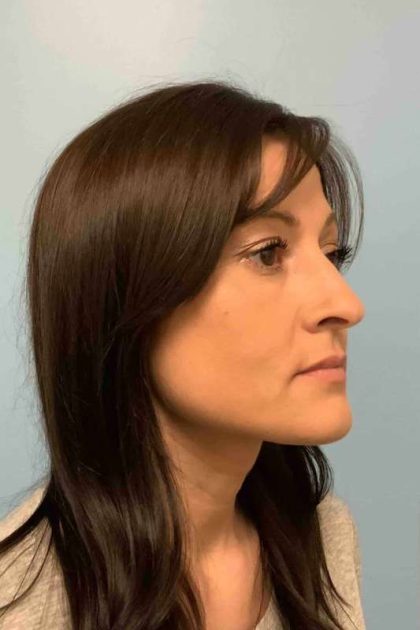 Fillers Before & After Patient #11288