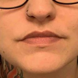 Fillers Before & After Patient #11291