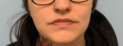 Fillers Before & After Patient #11291