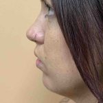 Fillers Before & After Patient #11298
