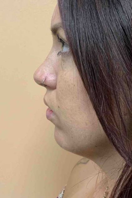 Fillers Before & After Patient #11298