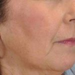 Fat Injections Before & After Patient #11357
