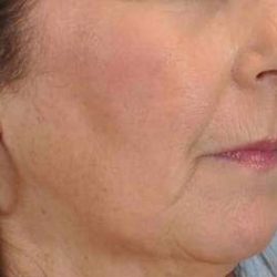 Fat Injections Before & After Patient #11357