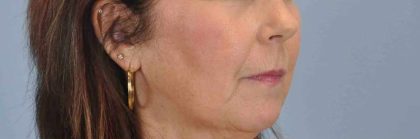 Fat Injections Before & After Patient #11357