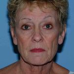 Facelift Before & After Patient #11364