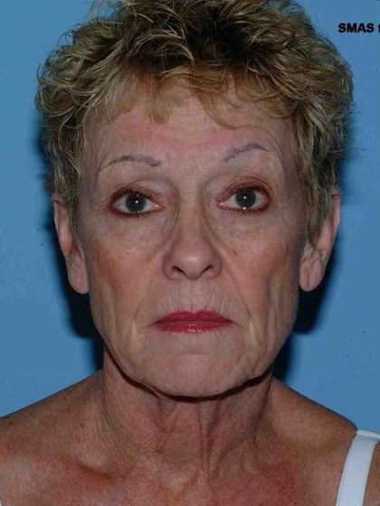 Facelift Before & After Patient #11364