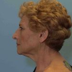 Facelift Before & After Patient #11371