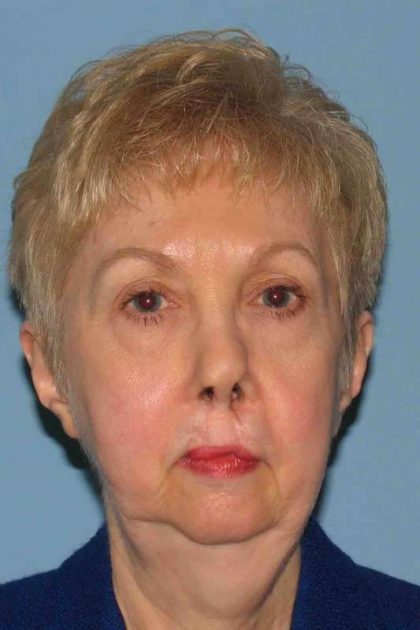 Facelift Before & After Patient #11403