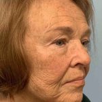 Facelift Before & After Patient #11410