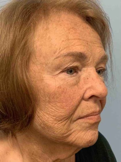 Facelift Before & After Patient #11410