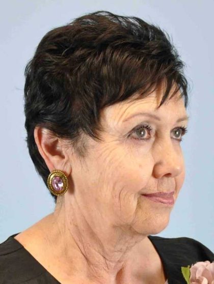 Facelift Before & After Patient #11431