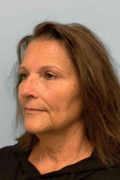 Facelift Before & After Patient #11450