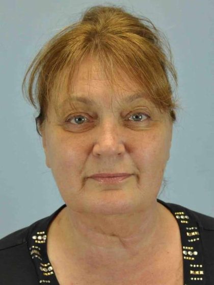 Eyelid Surgery Before & After Patient #11469