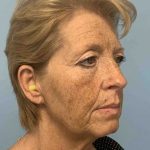 Eyelid Surgery Before & After Patient #11476