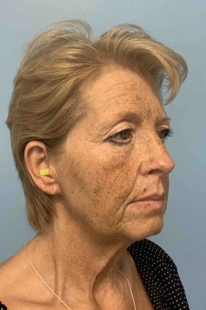 Eyelid Surgery Before & After Patient #11476