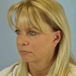 Eyelid Surgery Before & After Patient #11490
