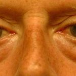 Eyelid Surgery Before & After Patient #11497