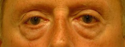 Eyelid Surgery Before & After Patient #11497