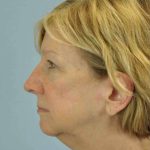 Eyelid Surgery Before & After Patient #11511