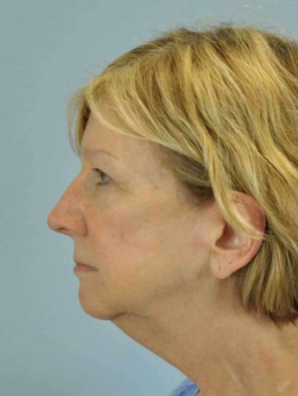 Eyelid Surgery Before & After Patient #11511