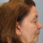 Eyelid Surgery Before & After Patient #11518
